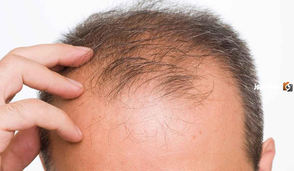 أفضل منتج للصلع الوراثي