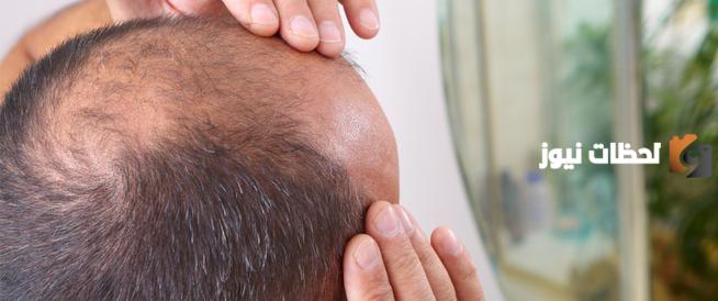 أفضل منتج للصلع الوراثي