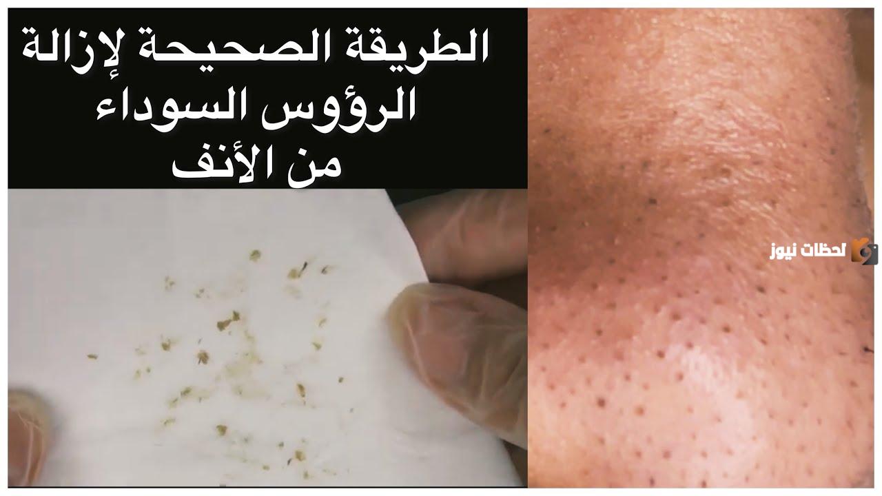 كيفية إزالة الرؤوس السوداء من الأنف
