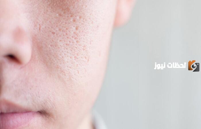 التخلص من المسامات الواسعة