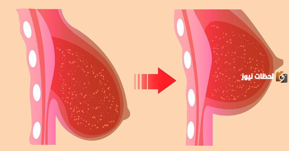أفضل علاج لشد الثدي