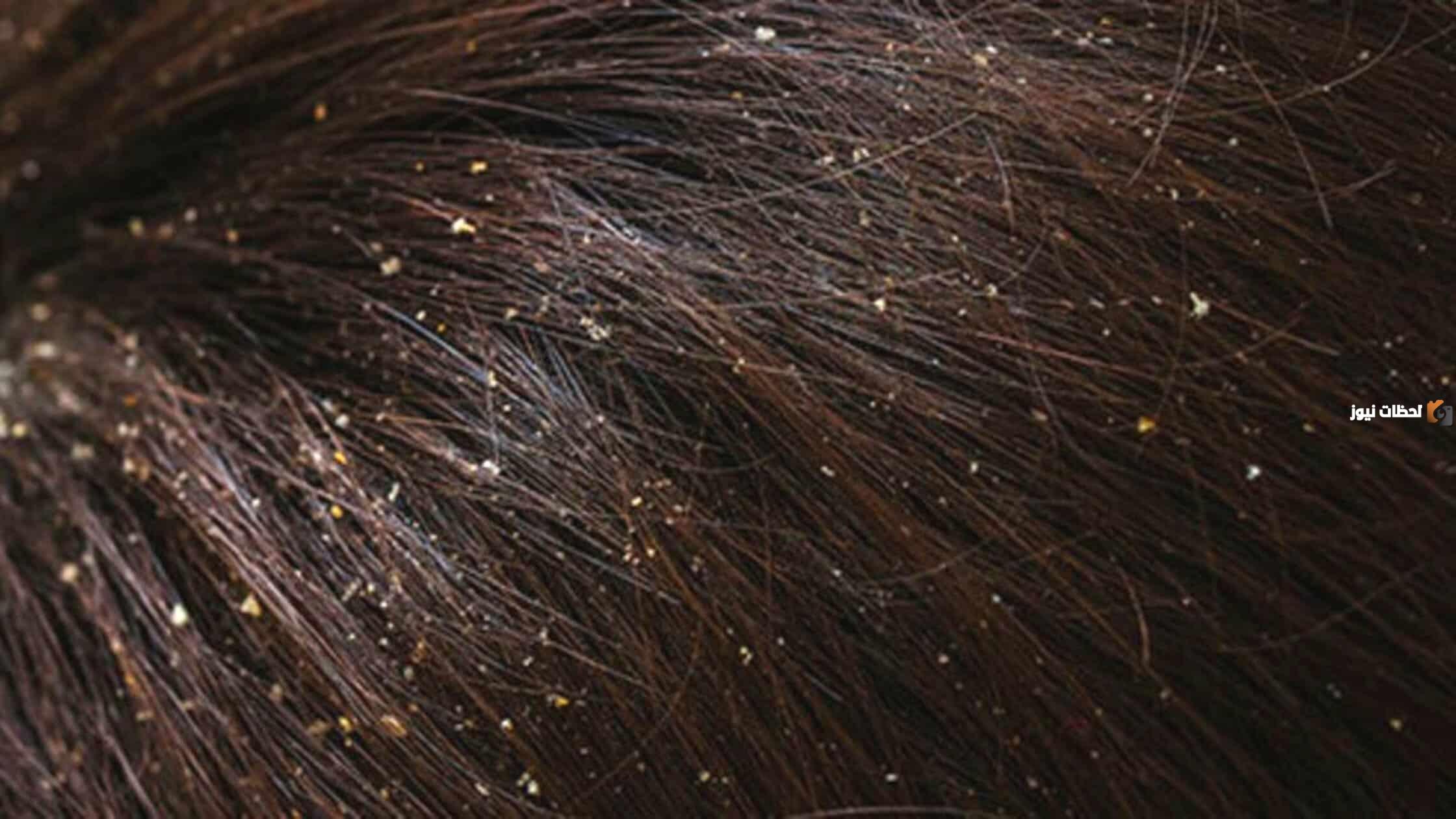 ما هو افضل شامبو طبي للقشرة للنساء