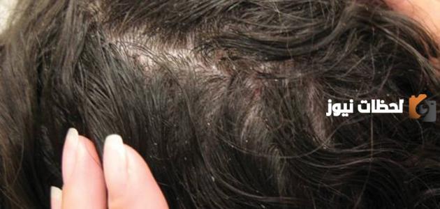 طريقة التخلص من بيض القمل