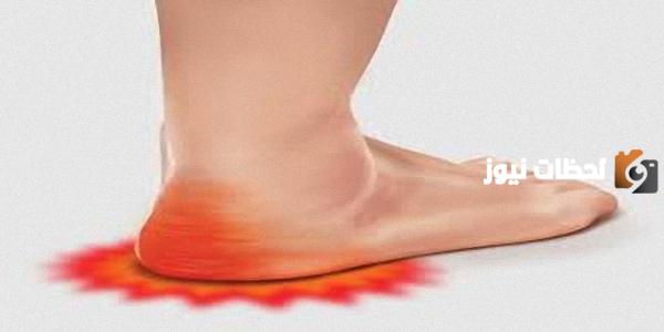 علاج القدم المسطحة Flat feet