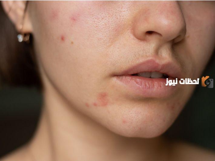 إزالة حب الشباب والبثور السوداء