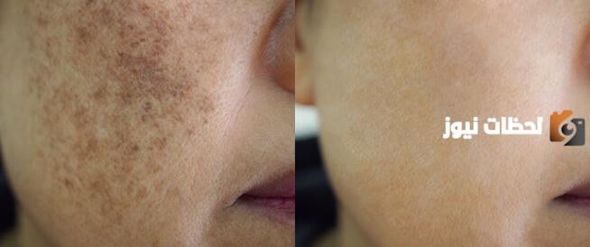 كيف تقشير الكلف في البيت