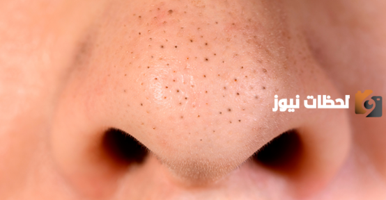 علاج الرؤوس السوداء