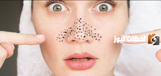 علاج الرؤوس السوداء