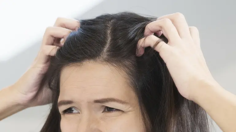 إزالة القشرة من الشعر بالليمون