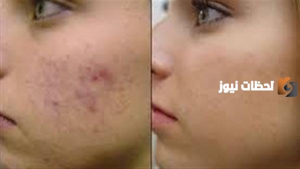 افضل كريم طبي لإزالة حب الشباب