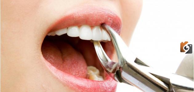 تفسير خلع الضرس في المنام للمتزوجة
