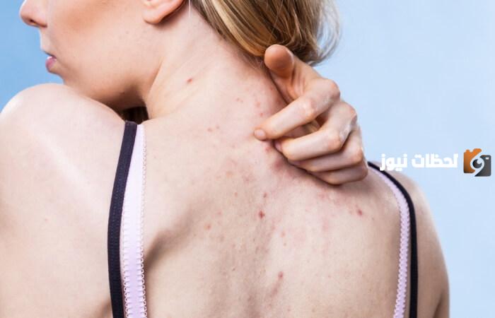 سبب ظهور الحبوب في الظهر والصدر وطريقة العلاج