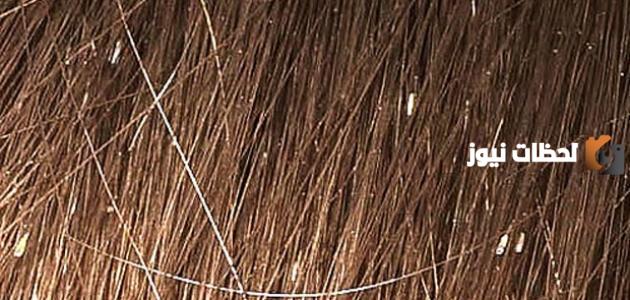 طريقة التخلص من بيض القمل