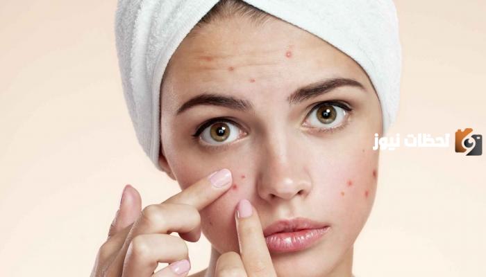 طريقة علاج حب الشباب بالأعشاب