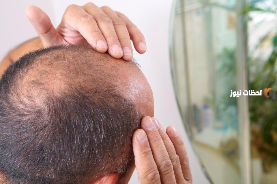 طريقة علاج صلع الشعر