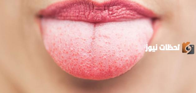 ظهور الحب في اللسان | متى تكون حبوب تحت اللسان خطيرة