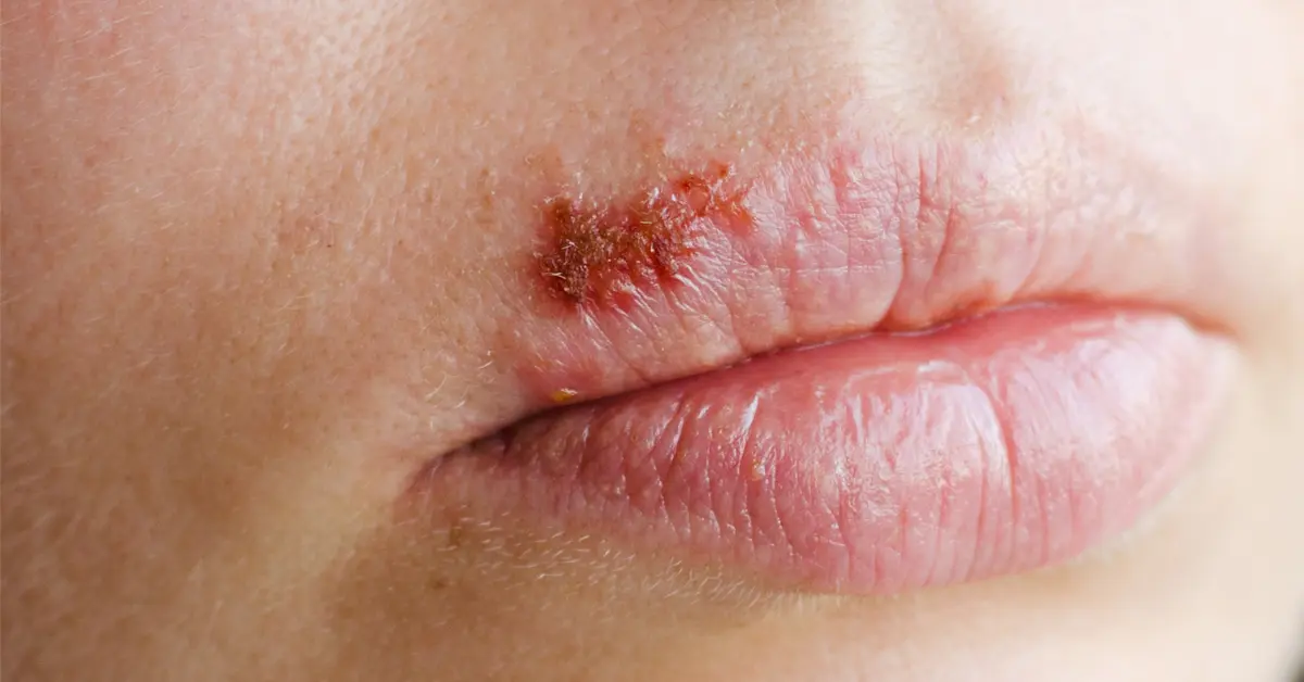 ظهور لطمة الحمى في الفم