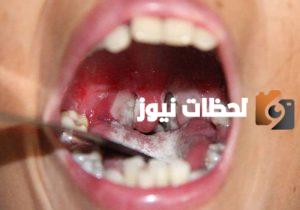علاج عدوى الديفتيرنا وطرق الوقاية