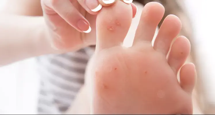 علاج عين السمكة