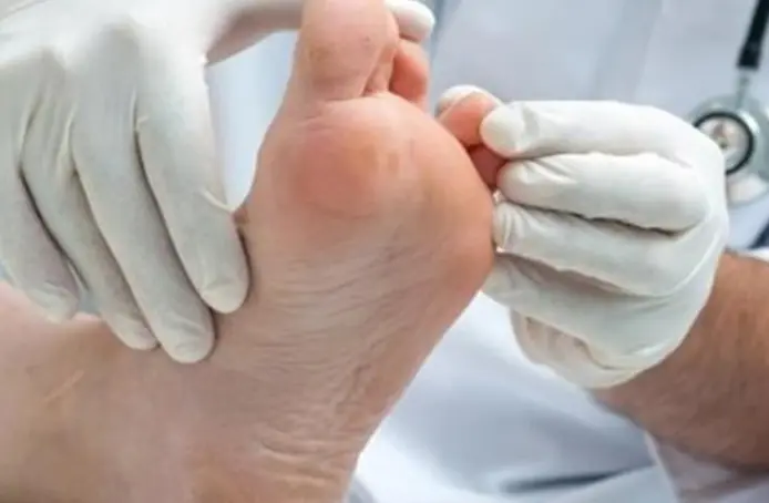 علاج عين السمكة