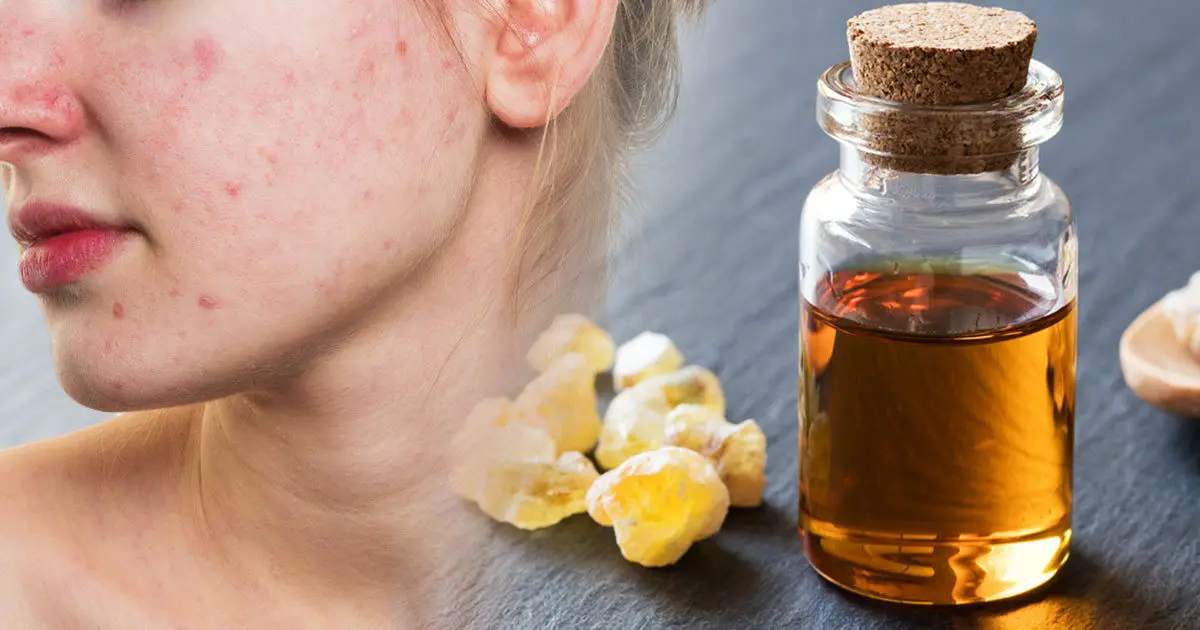 فوائد المرة للالتهابات