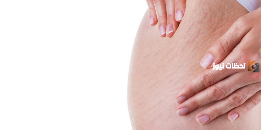 ما هو علاج الخطوط الحمراء في الجسم؟ طرق طبيعية في المنزل
