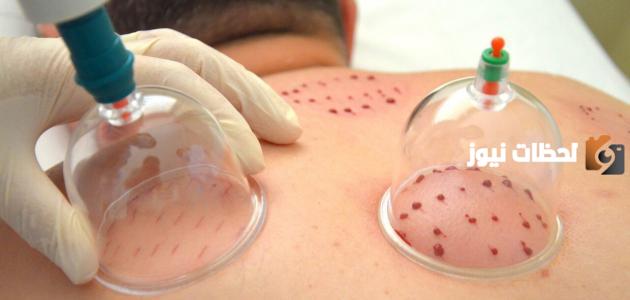 ماذا نأكل بعد الحجامة وما هي العادات المطلوبة بعدها