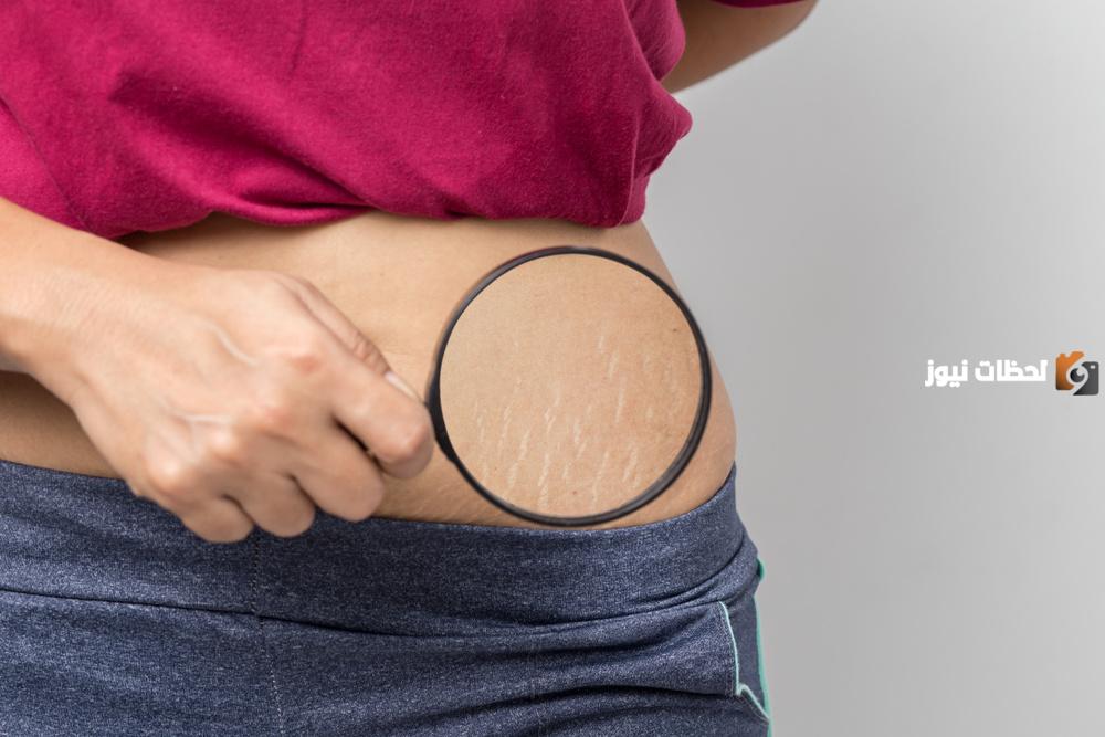 هل الخطوط البيضاء تروح بالليزر