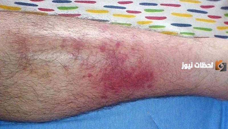 جميع  طرق علاج مرض الحمرة بالساق