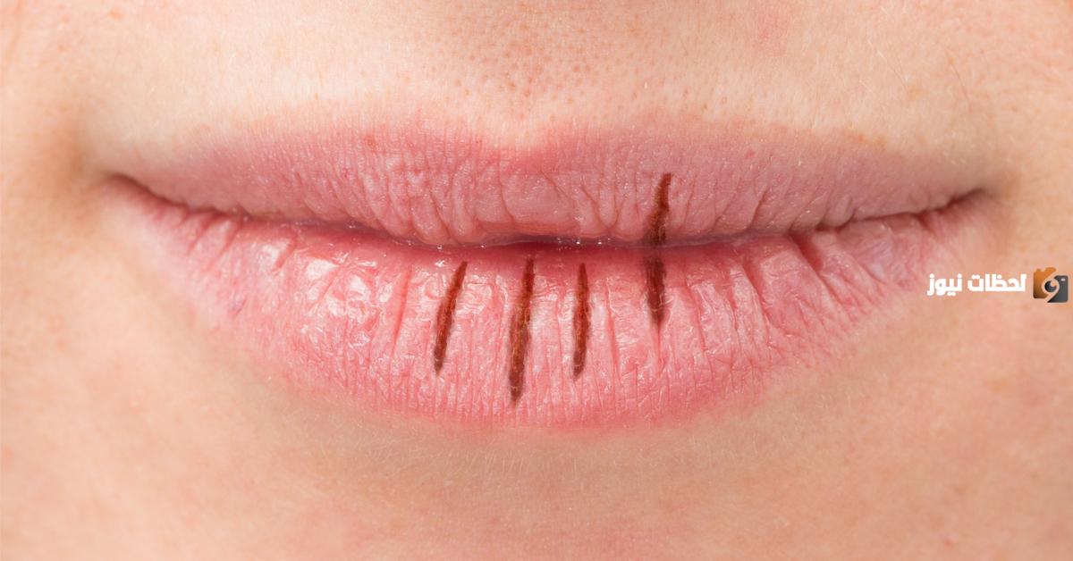 طرق التخلص من جفاف الشفايف