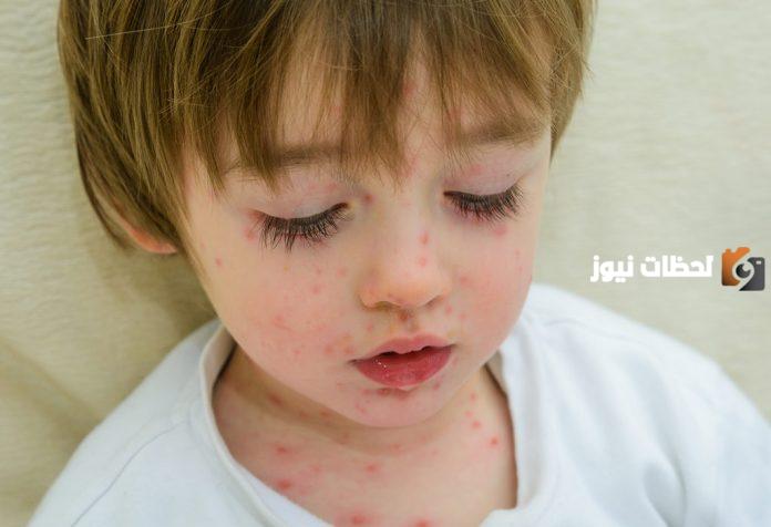 طريقة علاج مرض الجدري عند الاطفال بسرعة
