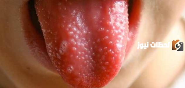 سبب ظهور الحبوب داخل الفم