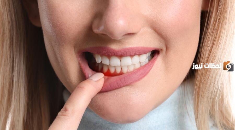 علاج اللثة بالأعشاب في المنزل بأسرع طريقة