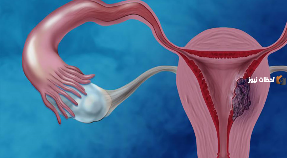 علاج تكيس المبايض بالاعشاب للدكتور جابر القحطاني
