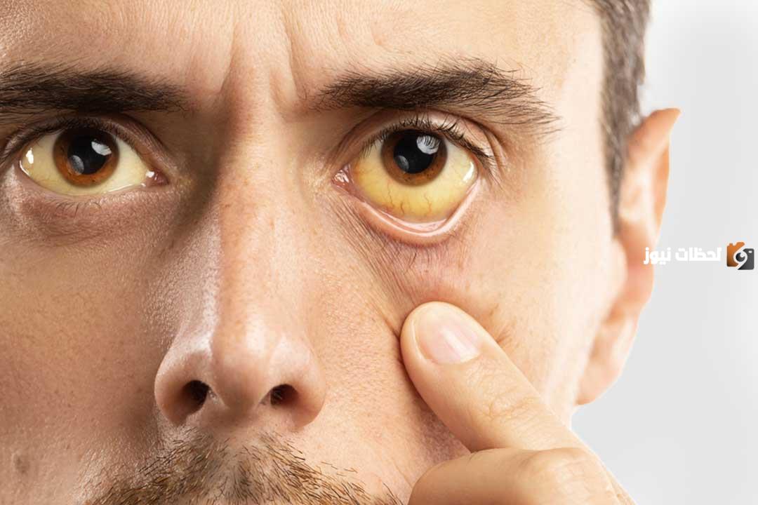 ما هي العلاقة بين الكبد واصفرار العين