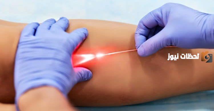 هل ضروري عمل عملية الدوالي؟ فوائد إجراء عملية الدوالي