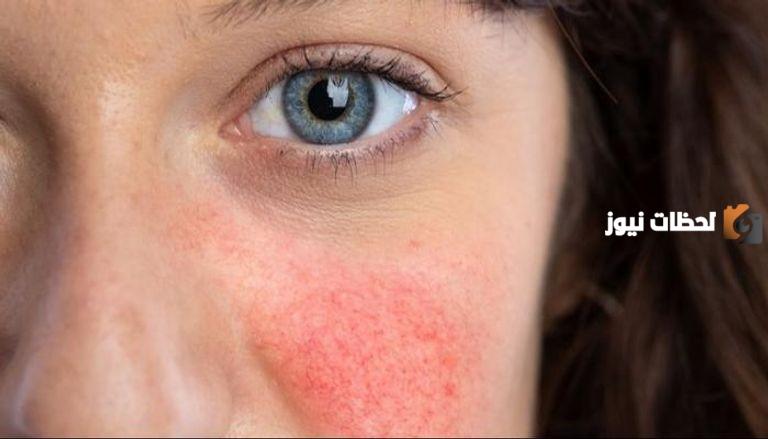 هل يمكن الشفاء من مرض الذئبة الحمراء؟ طرق علاج مرض الذئبة الحمراء