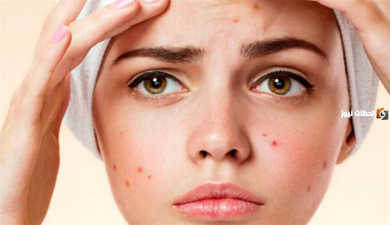وصفات علاج حب الشباب بالكركم1