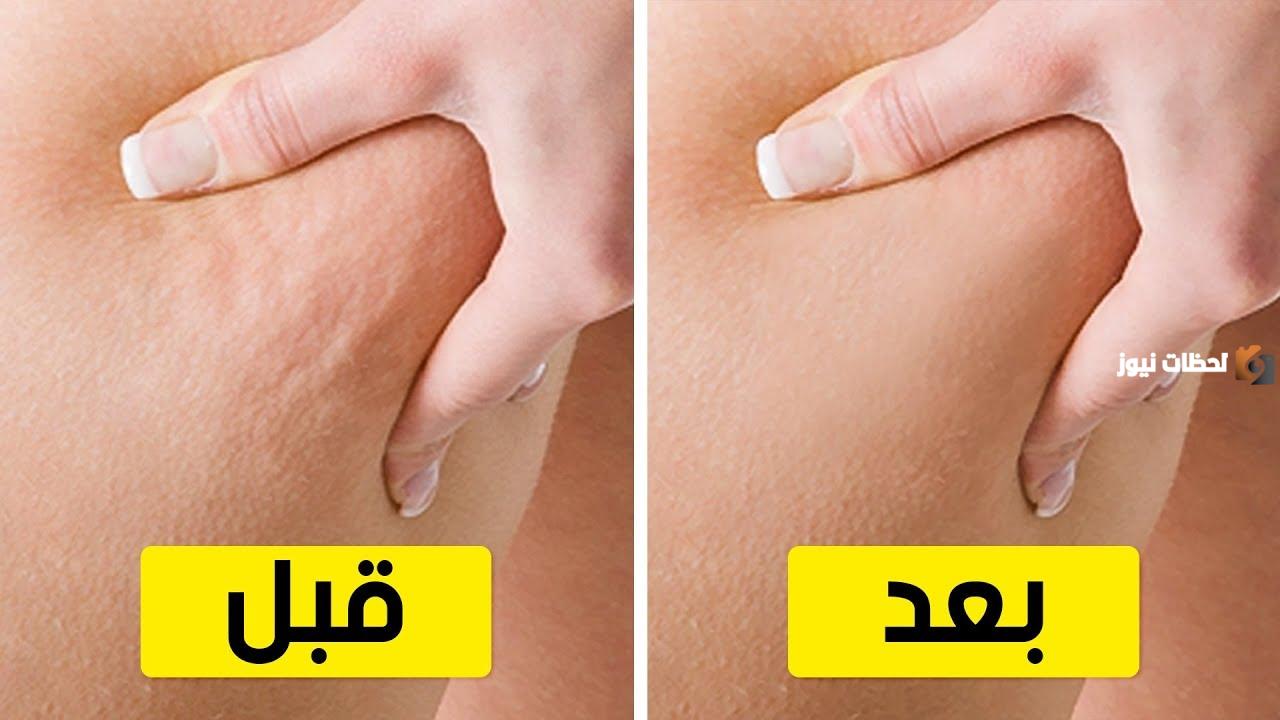 ما هي طريقة علاج السيلوليت في الجسم