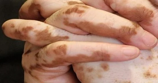 علاج البهاق بالأطعمة الغذائية