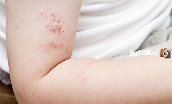 علاج الحزام الناري بالاعشاب بطريقة فعالة ومجربة