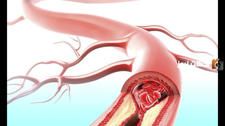 علاج قصور الشريان التاجي