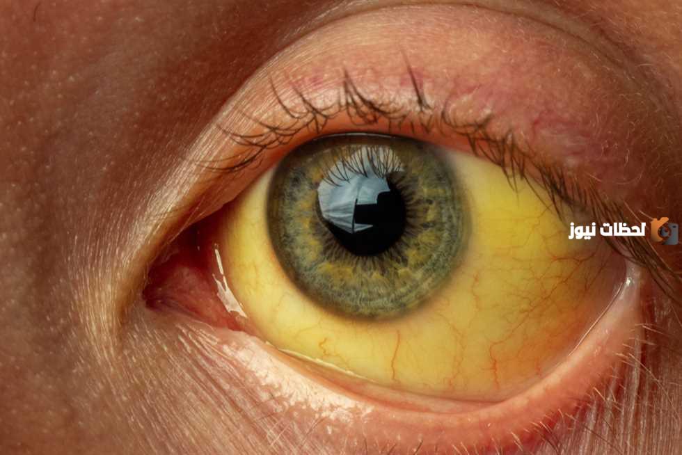 متى تكون نسبة الصفراء خطيرة