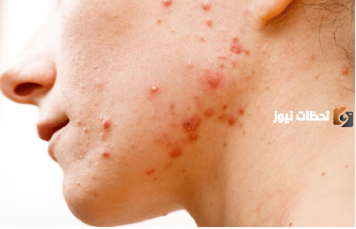 ما هو أفضل علاج ظهور حب الشباب