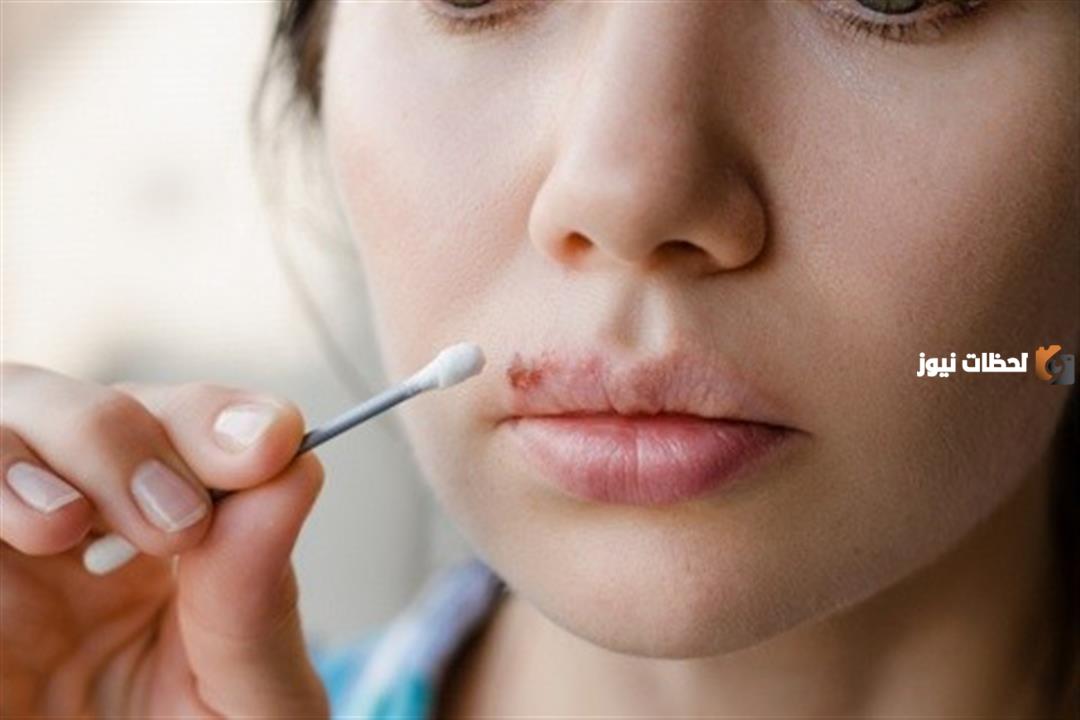 علاج حبة السخونة