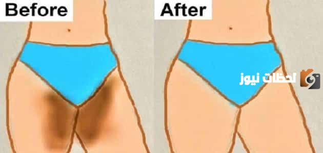 كريم لإزالة السواد بين الفخذين