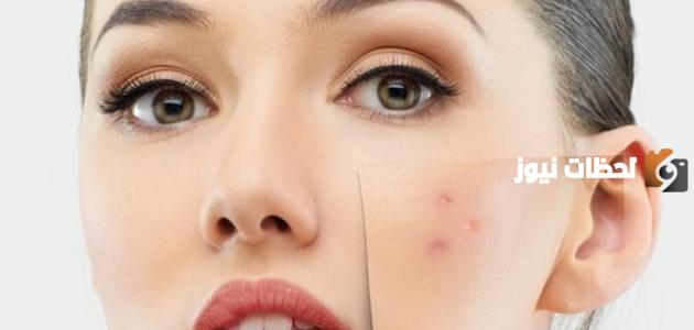 هل نت لوك يزيل آثار الحبوب