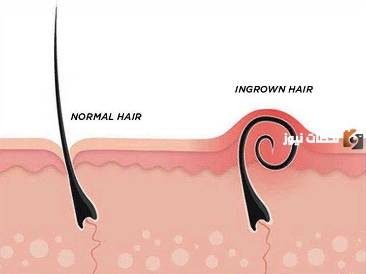 ما هو علاج نمو الشعر تحت الجلد فى الساقين