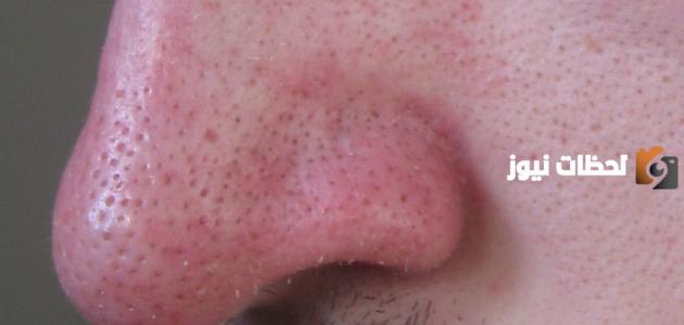 طرق التخلص من الرؤوس السوداء بطريقة صحيحة