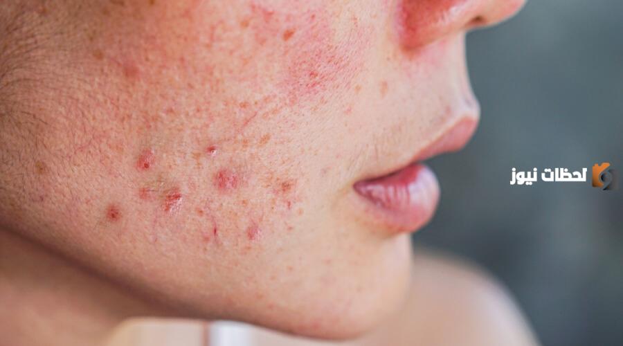 هل ظهور الحبوب من علامات خروج العين